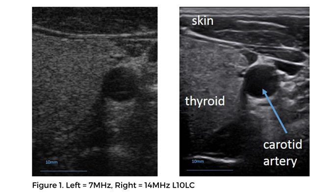 An L10LC thyroid scan compared to a traditional lower frequency transducer