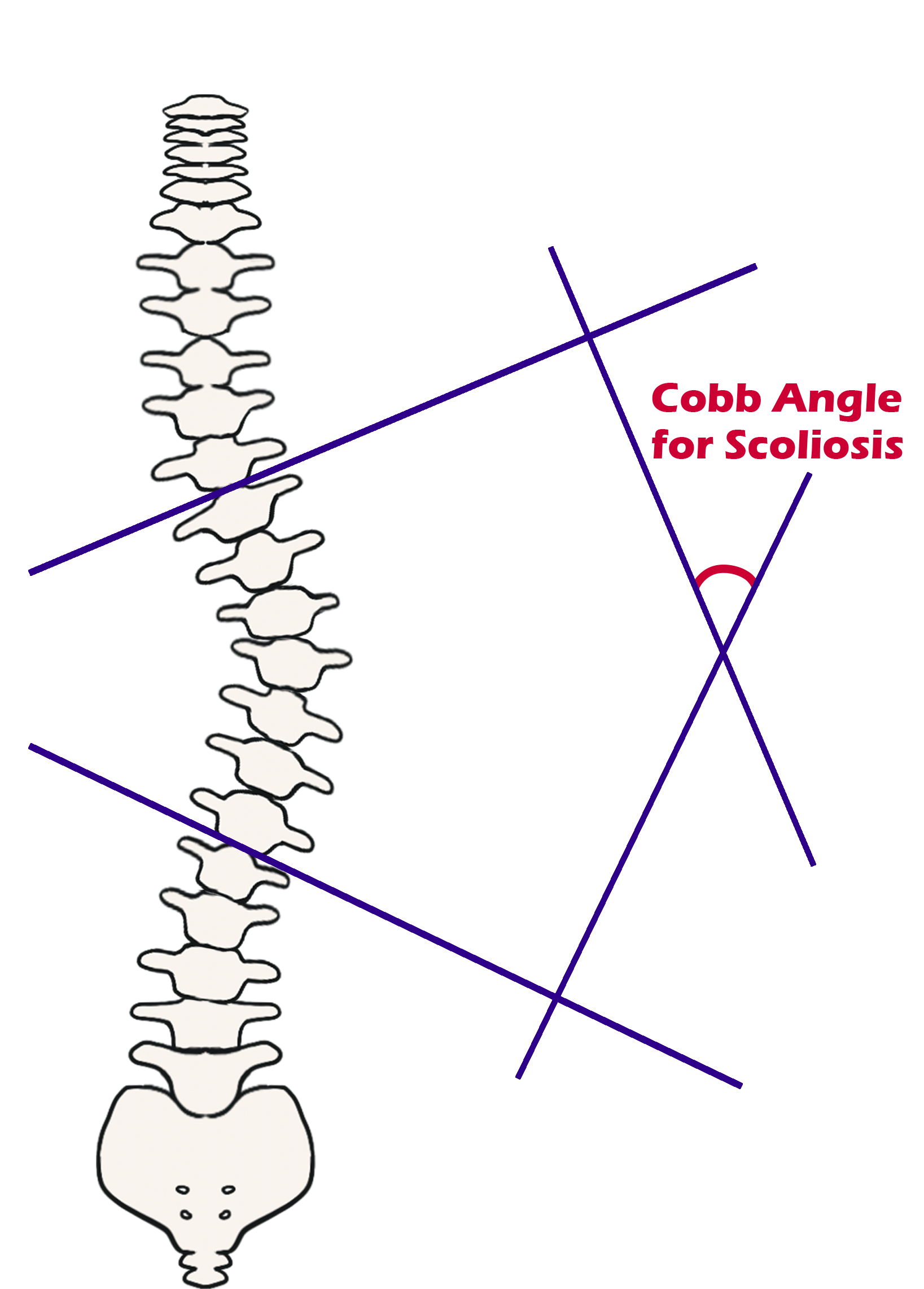 Cobb Angle