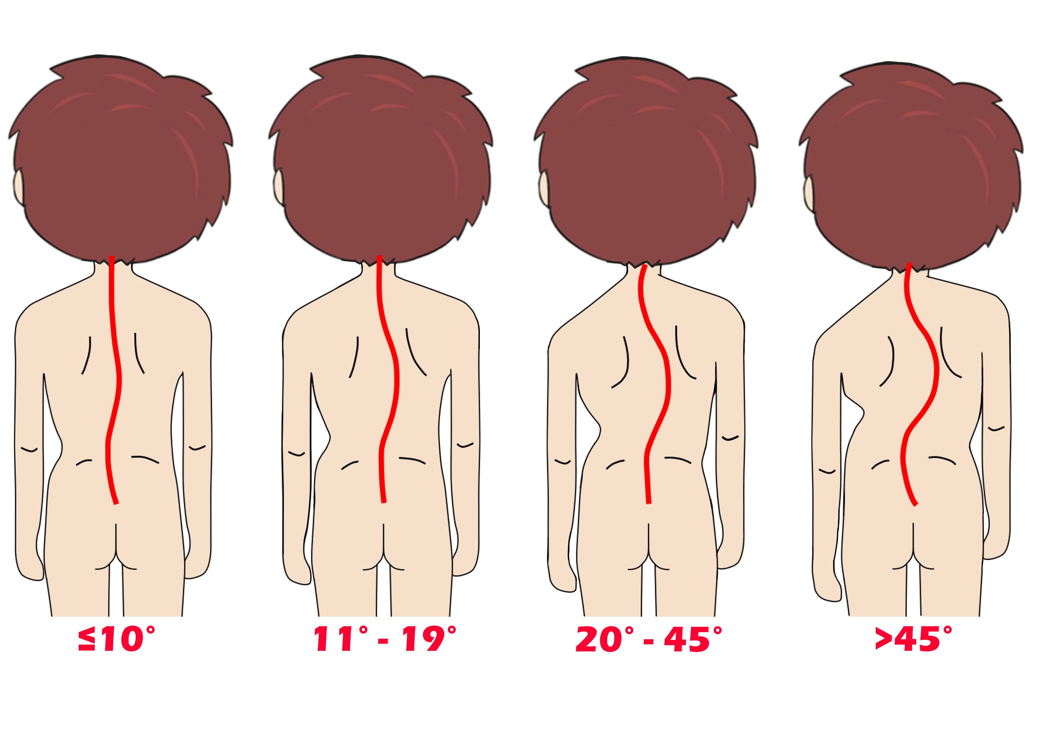 scoliosis degree