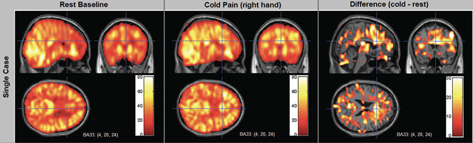 Three images of fMRI data. In each image, a brain is shown in cross-section (viewed from the right-hand side and from the back), with parts of it shaded red or yellow to indicate strength of brain activity. In the left and middle picture, the whole brain is shaded with activity. In the rightmost picture, there are several scattered blobs of activity.