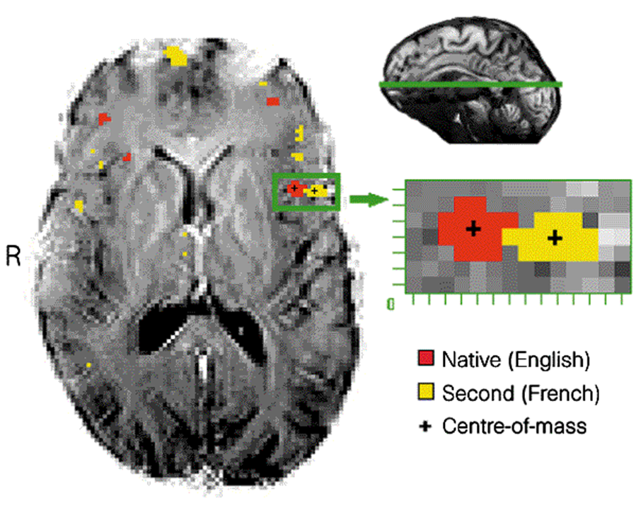 A view of a brain cross-section, looking down from the top. Several small areas are colored red (indicating brain activation [significantly more activity than baseline] for L1 speech) or yellow (indicating brain activation for L2 speech). The red and yellow brain areas do not overlap. Two of the red and yellow blobs, located in Broca's area, are highlighted with a green box and a zoomed-in view of them is shown off to the side.