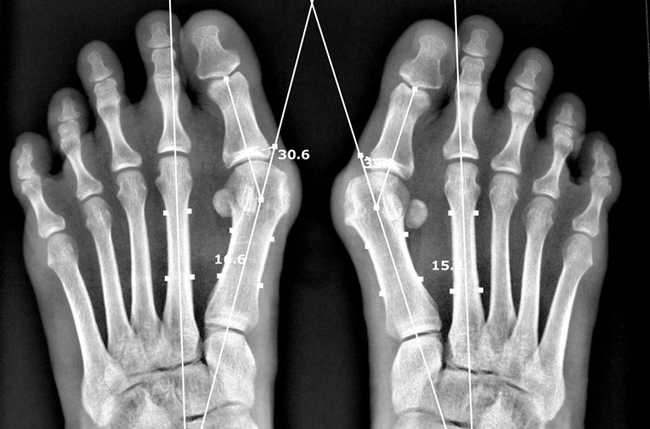 拇趾外翻變形足部之X光影像
