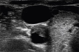 Cross-sectional image shows a carotid artery with plaque buildup.