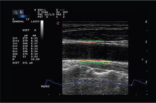 超聲波影像顯示頸動脈壁硬度。