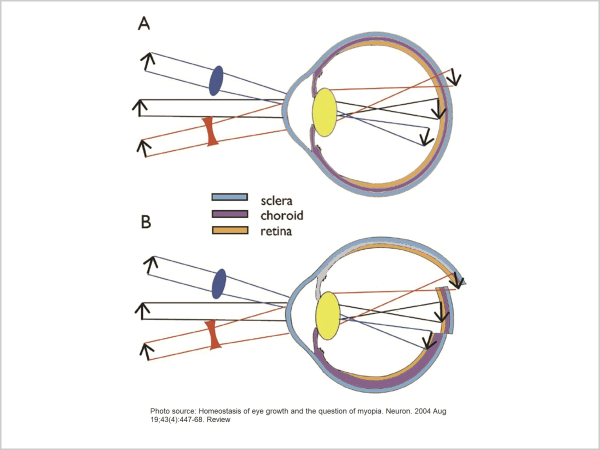 Ocular compensation