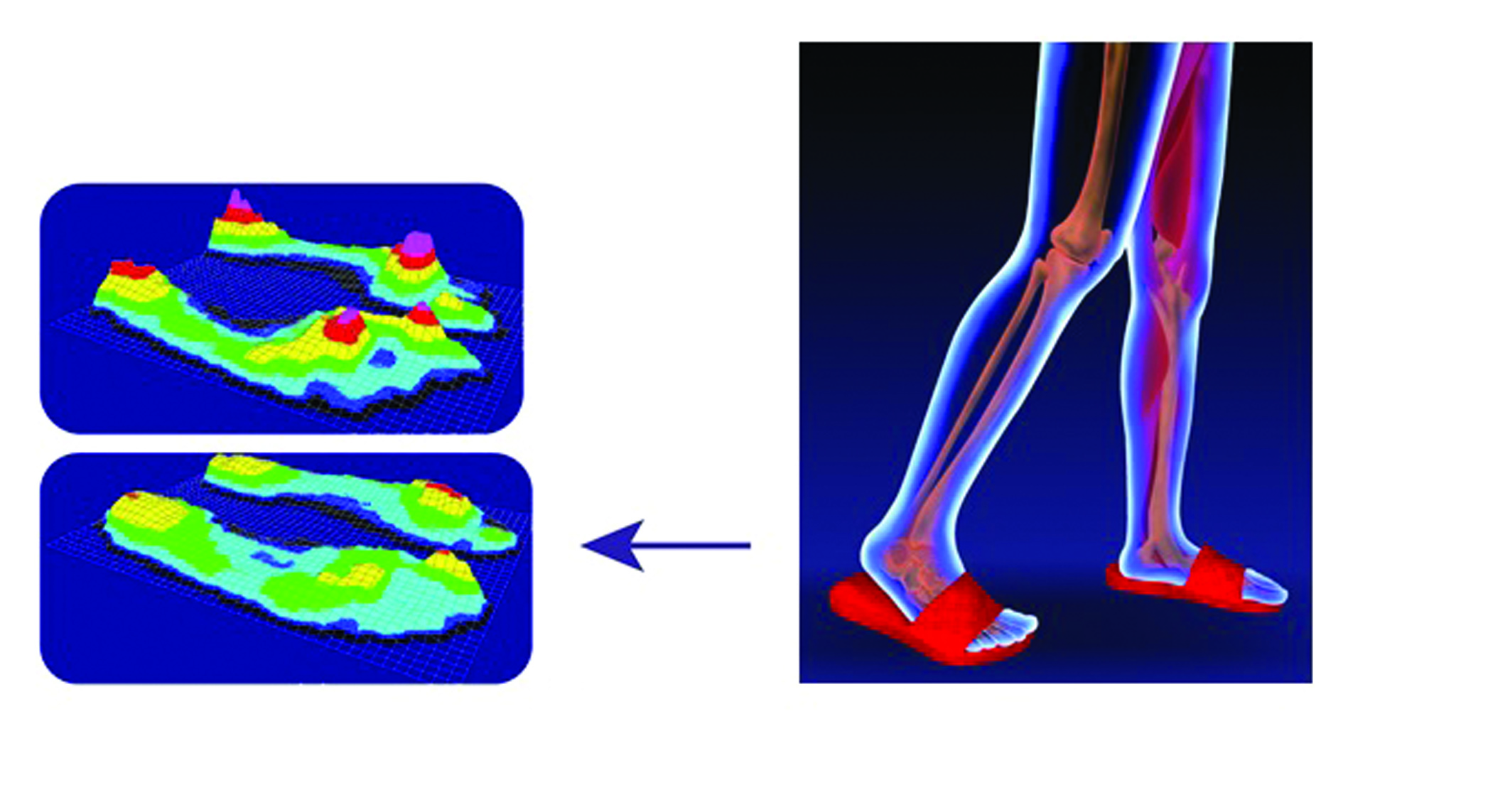 figure 1 plantar pressure distribution