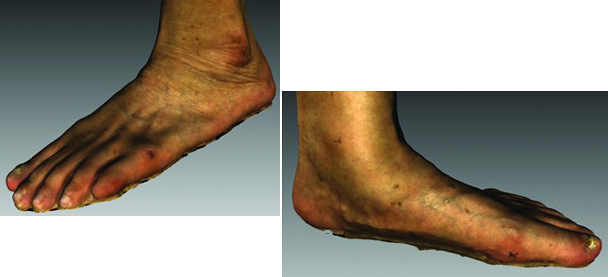 Figure 2 Foot conditions of older adutls
