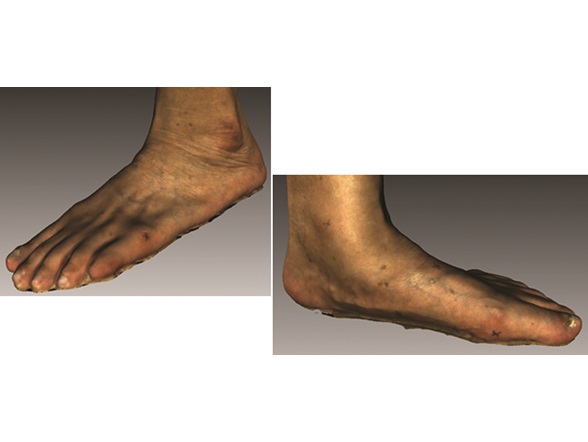 Figure 2 Foot conditions of older adutls