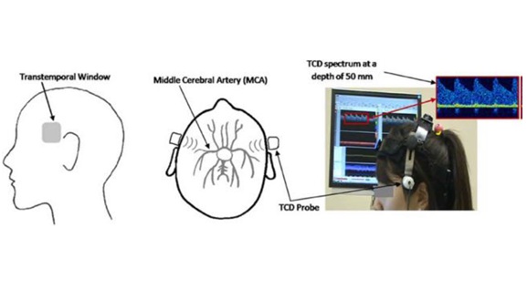 Ultrasound Imaging - dementia assessment