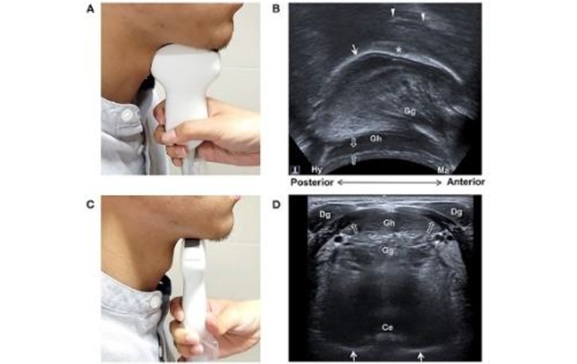 Ultrasound Imaging - swallowing disorder assessment