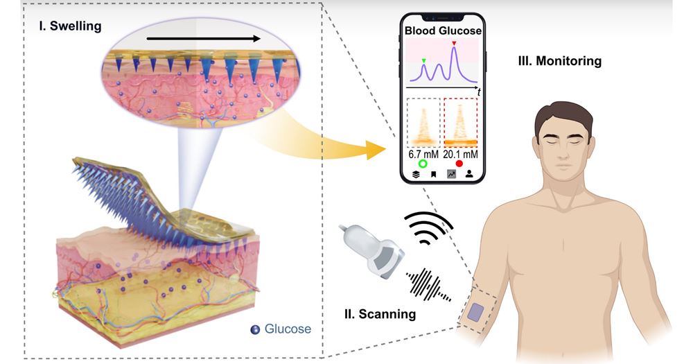 This innovation used conventional ultrasound imaging technology for continuous glucose monitoring, opening a new direction for ultrasound in wearable biosensing.