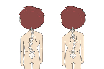 Adolescent Idiopathic Scoliosis (AIS)