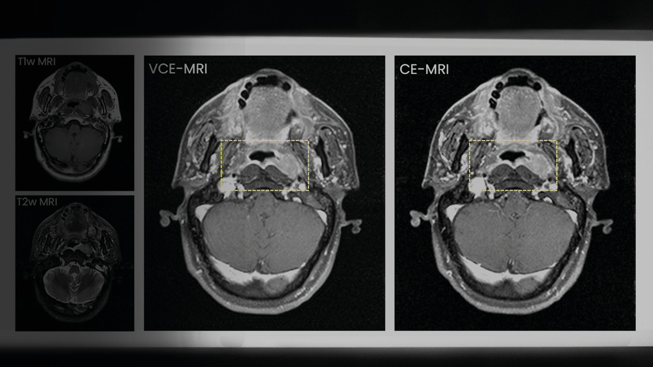 MRI