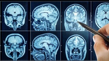 Sound Solution: A Breakthrough Approach to Parkinson's Disease