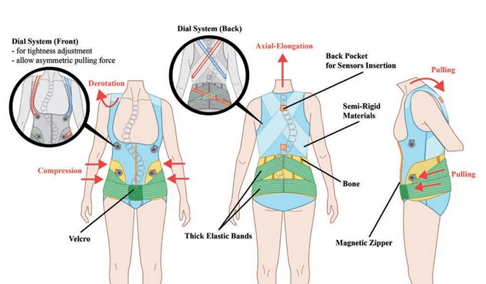 Posture Training Bodywear for Older Adults With Degenerative Scoliosis