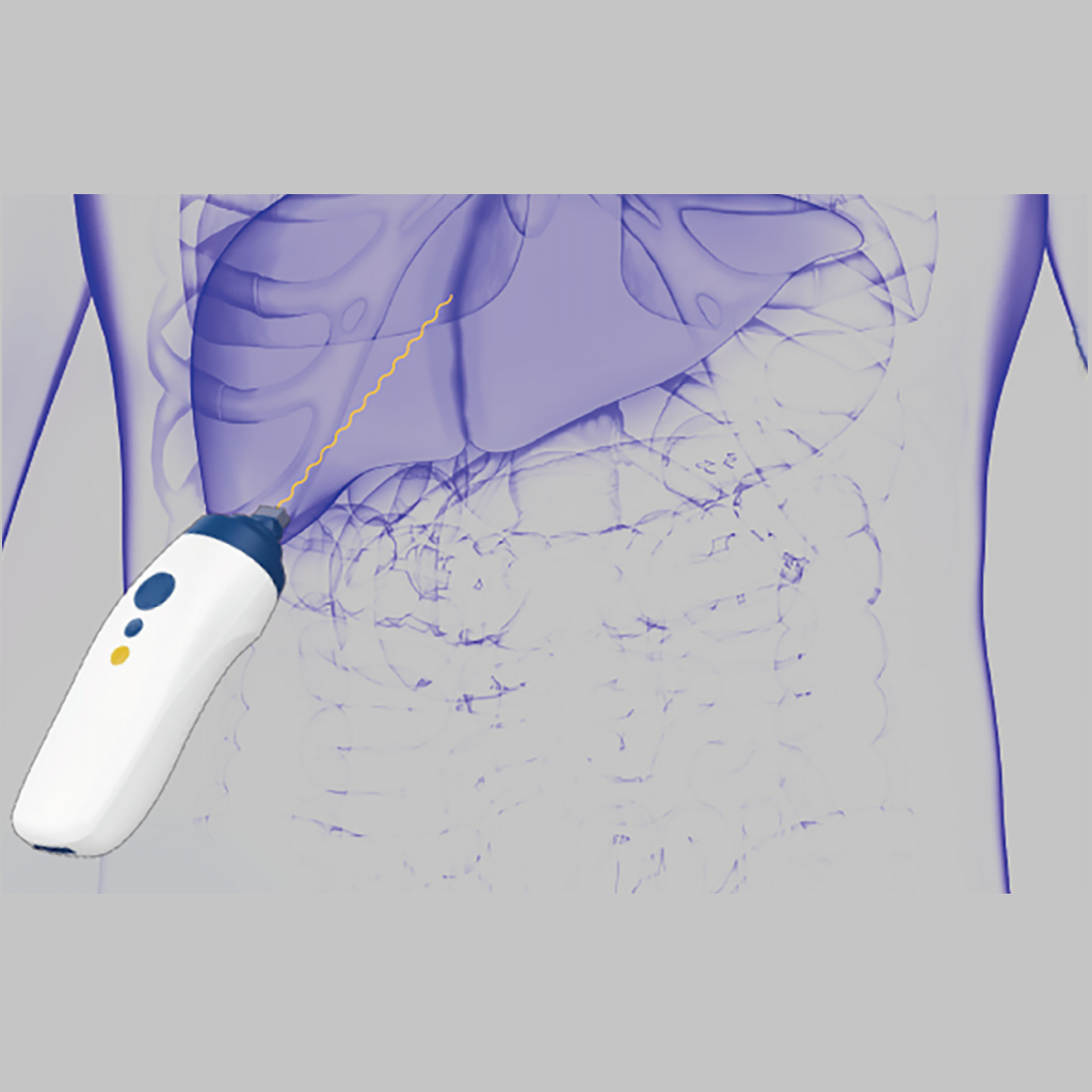 Liverscan®: Ultrasound Device for Liver Fibrosis and Steatosis ...