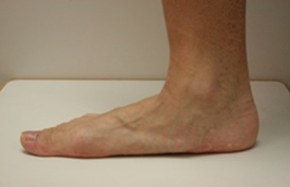 Flat Foot