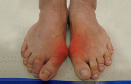 Hallux Valgus