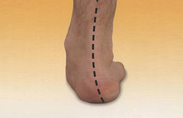 Without Orthotics