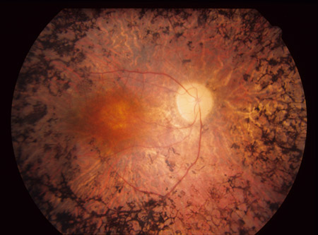 Retinitis_Pigmentosa_fundus