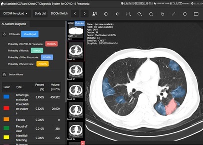 The interface of AI-assisted diagnostic system for COVID-19 pneumonia based on Chest Computed Tomography